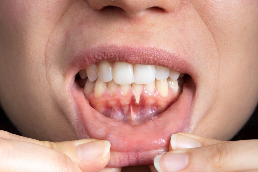 Preparing for teeth whitening with receding gums Dartford